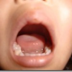 子供の口内炎の時の治療